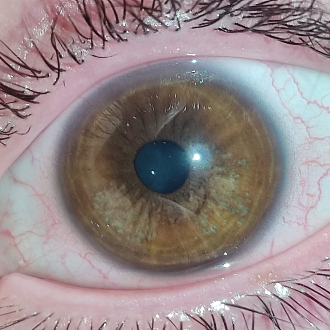 Close-up of the same iris after treatment, now amber and hazel