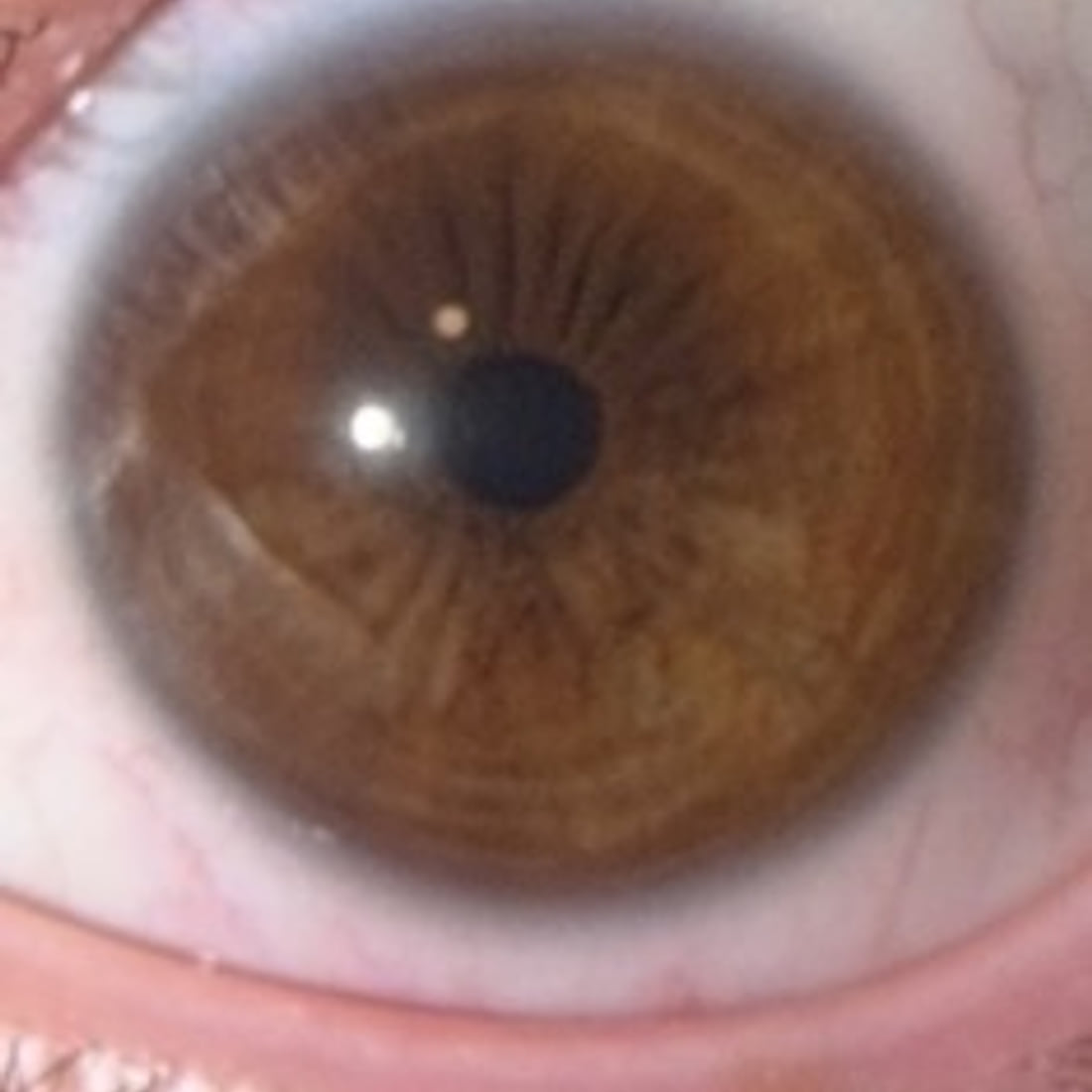Close-up of a dark brown iris before treatment