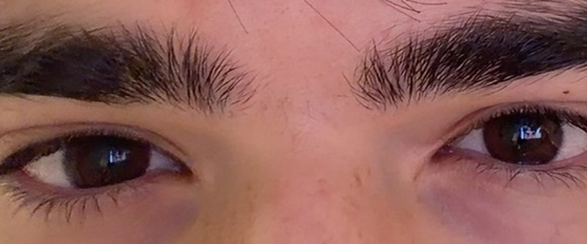 Both eyes before treatment, dark brown